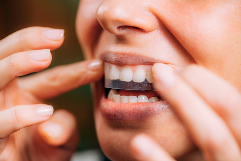 Understanding the Different Teeth Whitening Options
